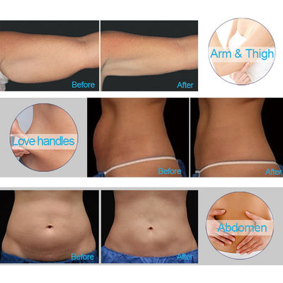 Pendinginan Cryo Fat Freezing Berat Badan Penurunan Lemak Mesin Cryolipolysis